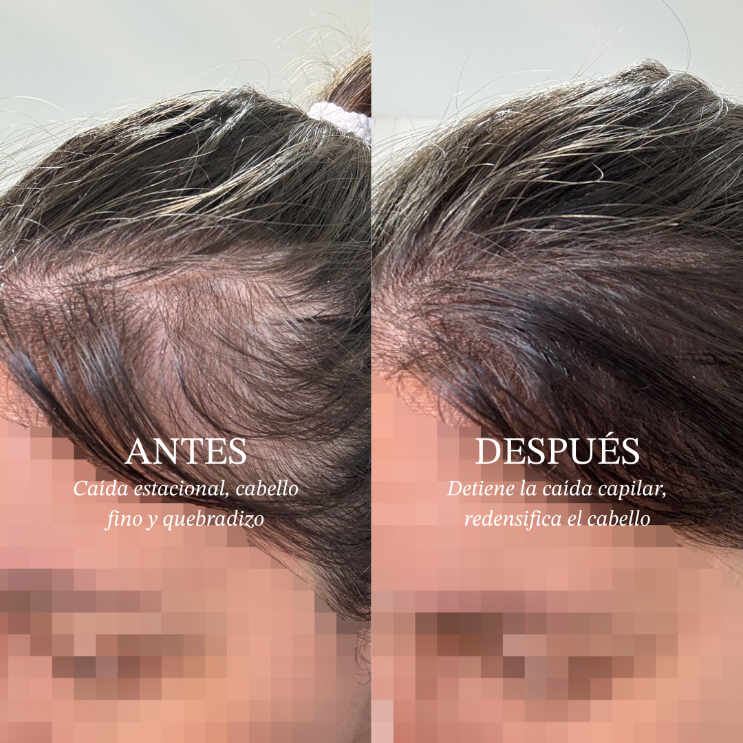 Cabello Dañado Pelo Quemado Por Alisado Japones Pelo Quemado