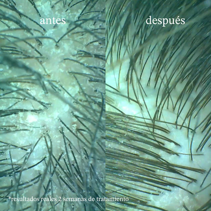 Tratamiento completo anti raíces grasas